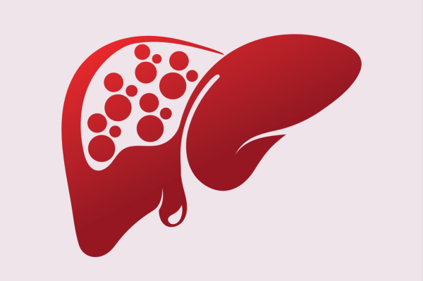 Reducing weight is the first step! Nutritionists teach 7 tips to reverse fatty liver and prevent liver cancer